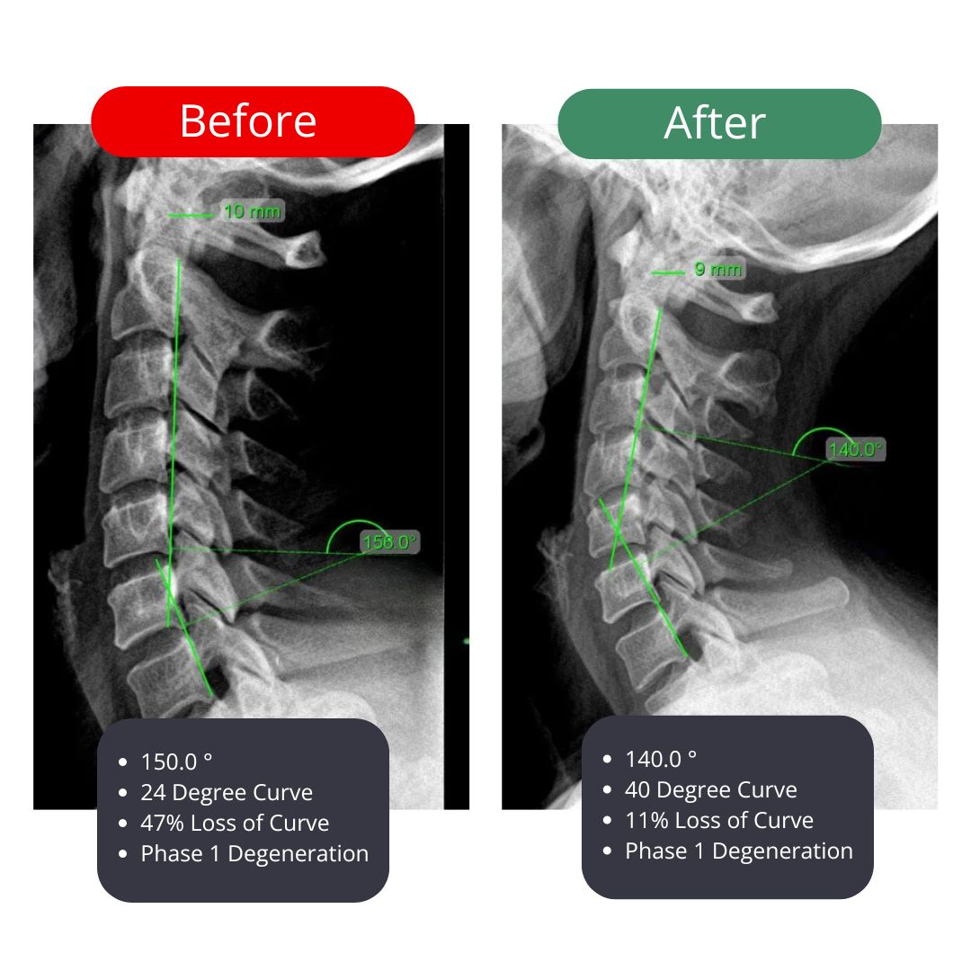 FixPosture NeckGuard™